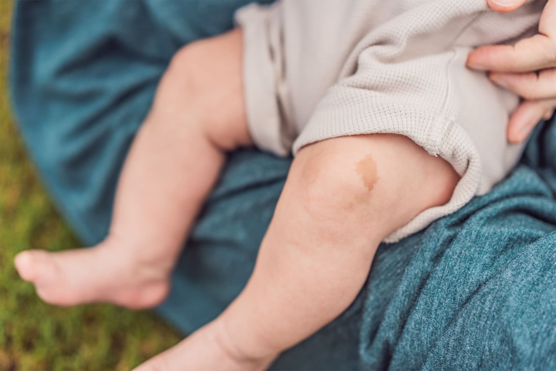 Marca de nacimiento en la pierna de un bebé.